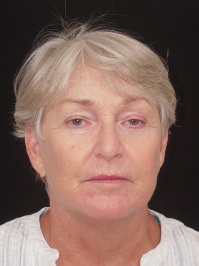 After Image: Facelifts/Necklifts - front