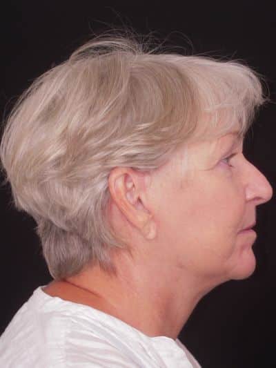 After Image: Facelifts/Necklifts - right-side