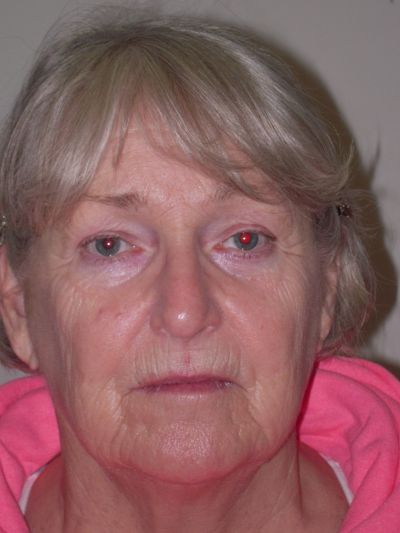 Before Image: Facelifts/Necklifts - front