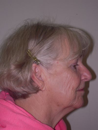 Before Image: Facelifts/Necklifts - right-side