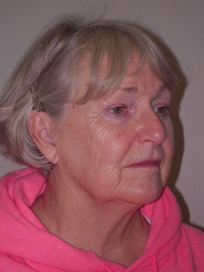 Before Image: Facelifts/Necklifts - right-front-oblique
