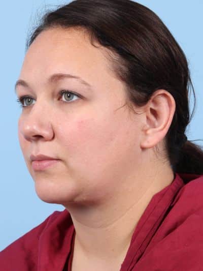 After Image: Facelifts/Necklifts - left-front-oblique