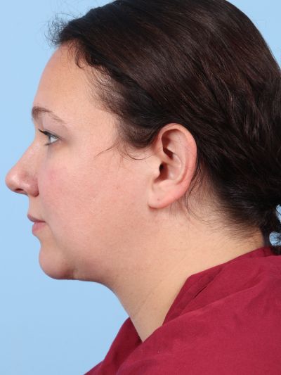 After Image: Facelifts/Necklifts - left-side