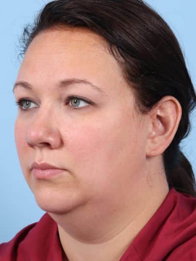 Before Image: Facelifts/Necklifts - left-front-oblique