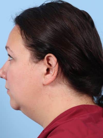 Before Image: Facelifts/Necklifts - left-side
