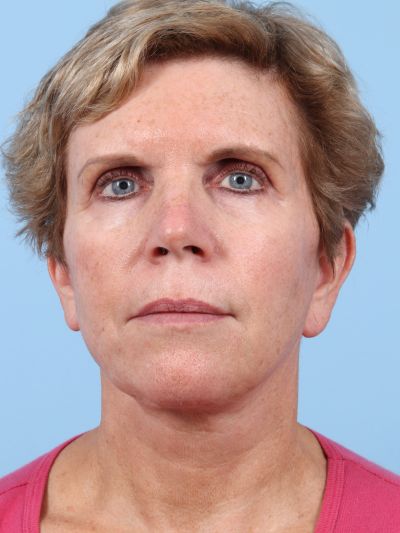 After Image: Facelifts/Necklifts - front