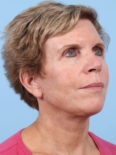 After Image: Facelifts/Necklifts - right-front-oblique