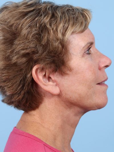 After Image: Facelifts/Necklifts - right-side