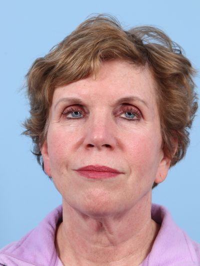 Before Image: Facelifts/Necklifts - front