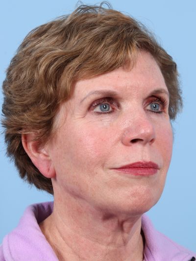 Before Image: Facelifts/Necklifts - right-front-oblique