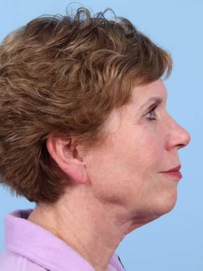 Before Image: Facelifts/Necklifts - right-side