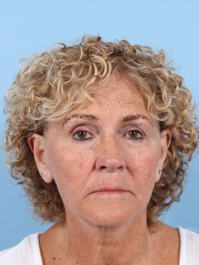 After Image: Facelifts/Necklifts - front