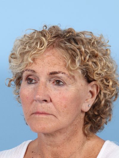 After Image: Facelifts/Necklifts - left-front-oblique