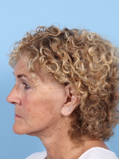 After Image: Facelifts/Necklifts - left-side