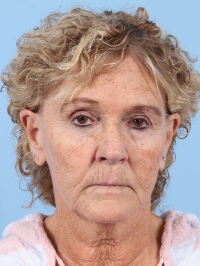 Before Image: Facelifts/Necklifts - front