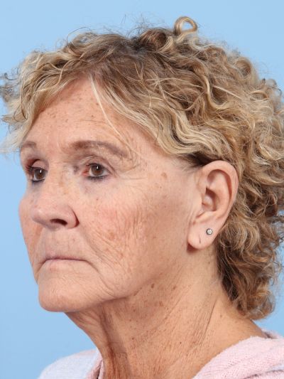 Before Image: Facelifts/Necklifts - left-front-oblique