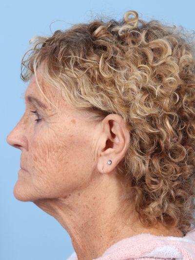 Before Image: Facelifts/Necklifts - left-side