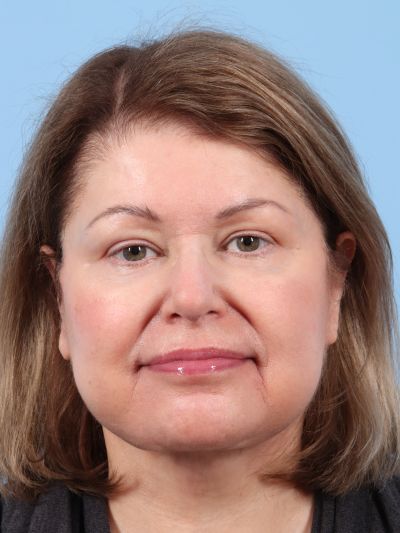 After Image: Facelifts/Necklifts - front