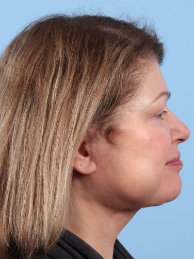 After Image: Facelifts/Necklifts - right-side