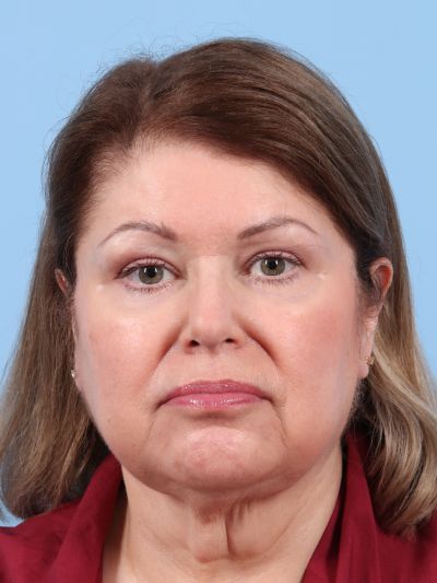 Before Image: Facelifts/Necklifts - front