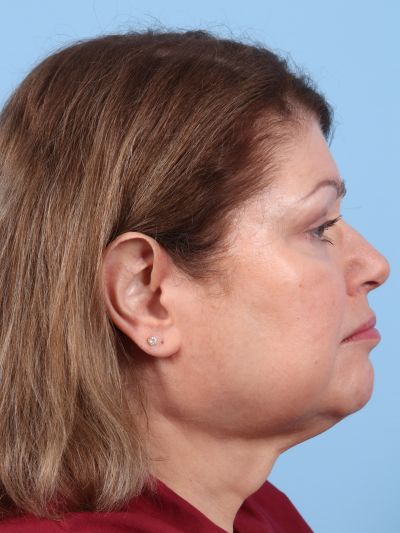 Before Image: Facelifts/Necklifts - right-side