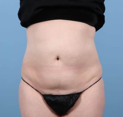 After Image: Liposuction - front
