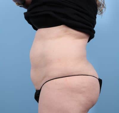 After Image: Liposuction - left-side