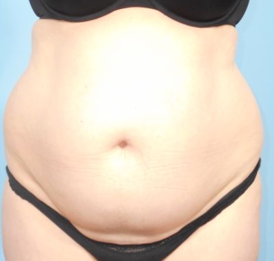 Before Image: Liposuction - front