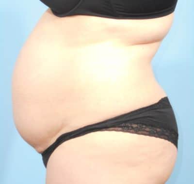 Before Image: Liposuction - left-side