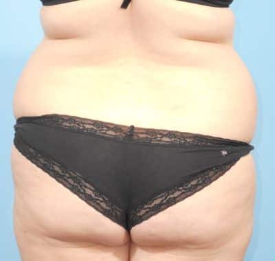 Before Image: Liposuction - back