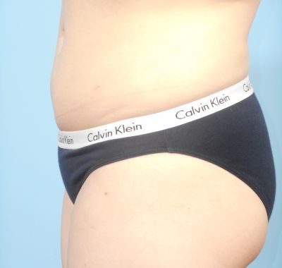 After Image: Liposuction - left-side