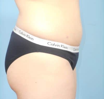 After Image: Liposuction - right-side