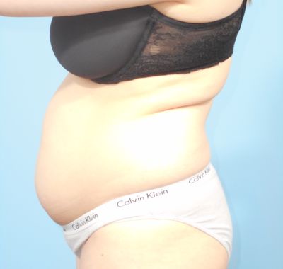 Before Image: Liposuction - left-side
