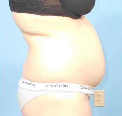 Before Image: Liposuction - right-side