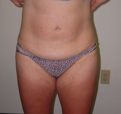 After Image: Liposuction - front