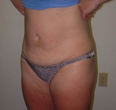 After Image: Liposuction - left-front-oblique