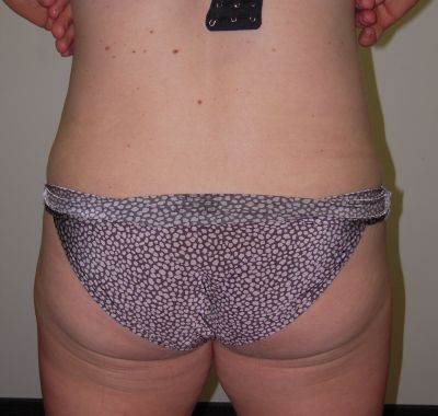 After Image: Liposuction - back