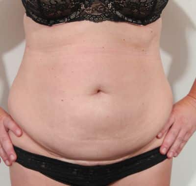 Before Image: Liposuction - front