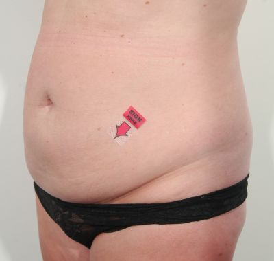 Before Image: Liposuction - left-front-oblique