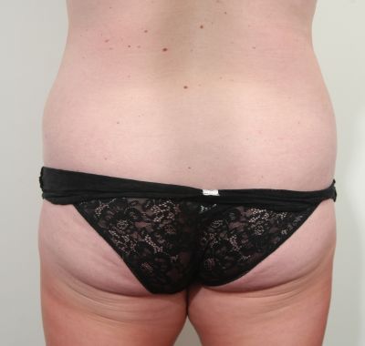 Before Image: Liposuction - back