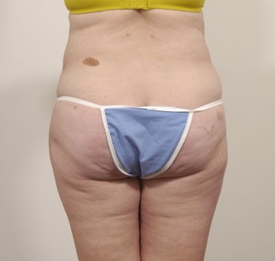 After Image: Liposuction - back
