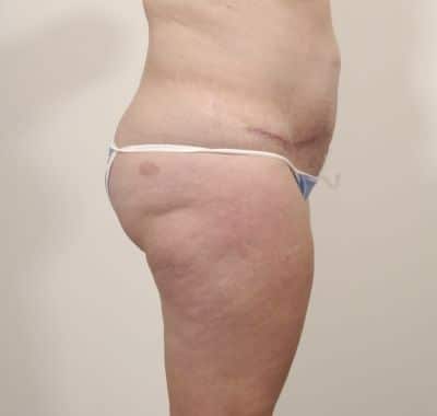After Image: Liposuction - right-side