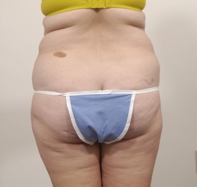 Before Image: Liposuction - back