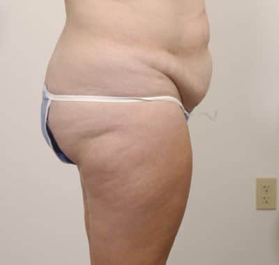 Before Image: Liposuction - right-side