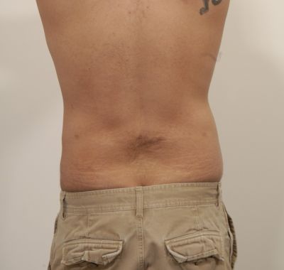 After Image: Liposuction - back