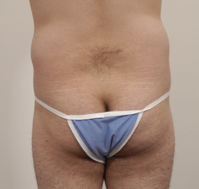 Before Image: Liposuction - back