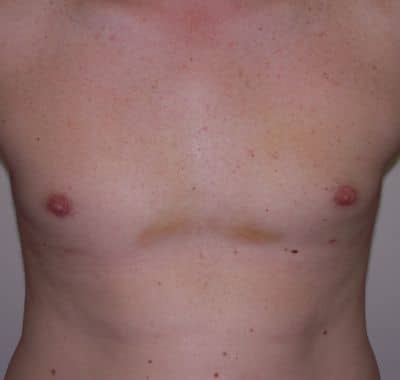 After Image: Male Breast Reduction - front