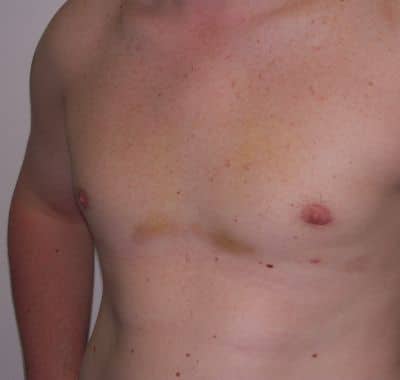 After Image: Male Breast Reduction - left-front-oblique