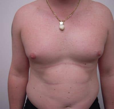 Before Image: Male Breast Reduction - front