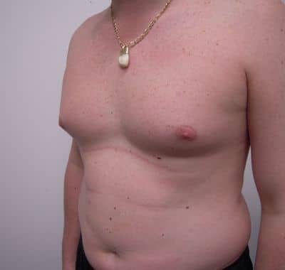 Before Image: Male Breast Reduction - left-front-oblique